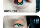解梦双眼出血预兆