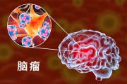 脑瘤是什么不好?师教你避开脑瘤的秘密 脑瘤是什么不好?师教你避开脑瘤的秘密