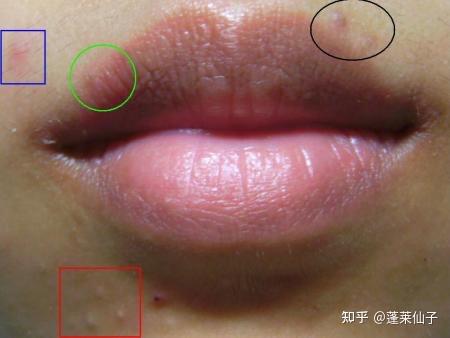 口角长痘解析，隐藏的健康与运势密码,命运,挑战,能量,第1张