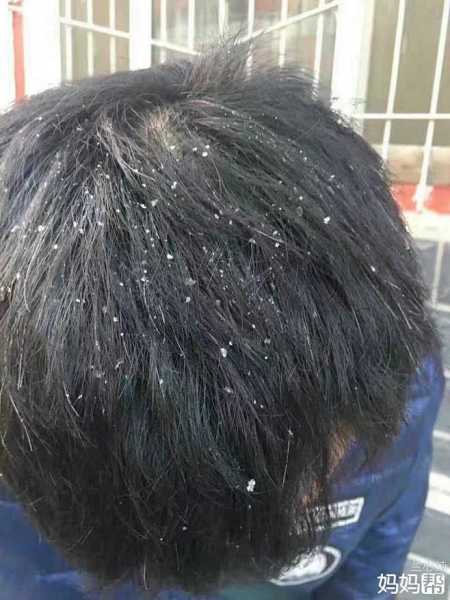 解梦头上有头皮屑什么意思,象征,挑战,自我,第1张 解梦头上有头皮屑什么意思,象征,挑战,自我,第1张