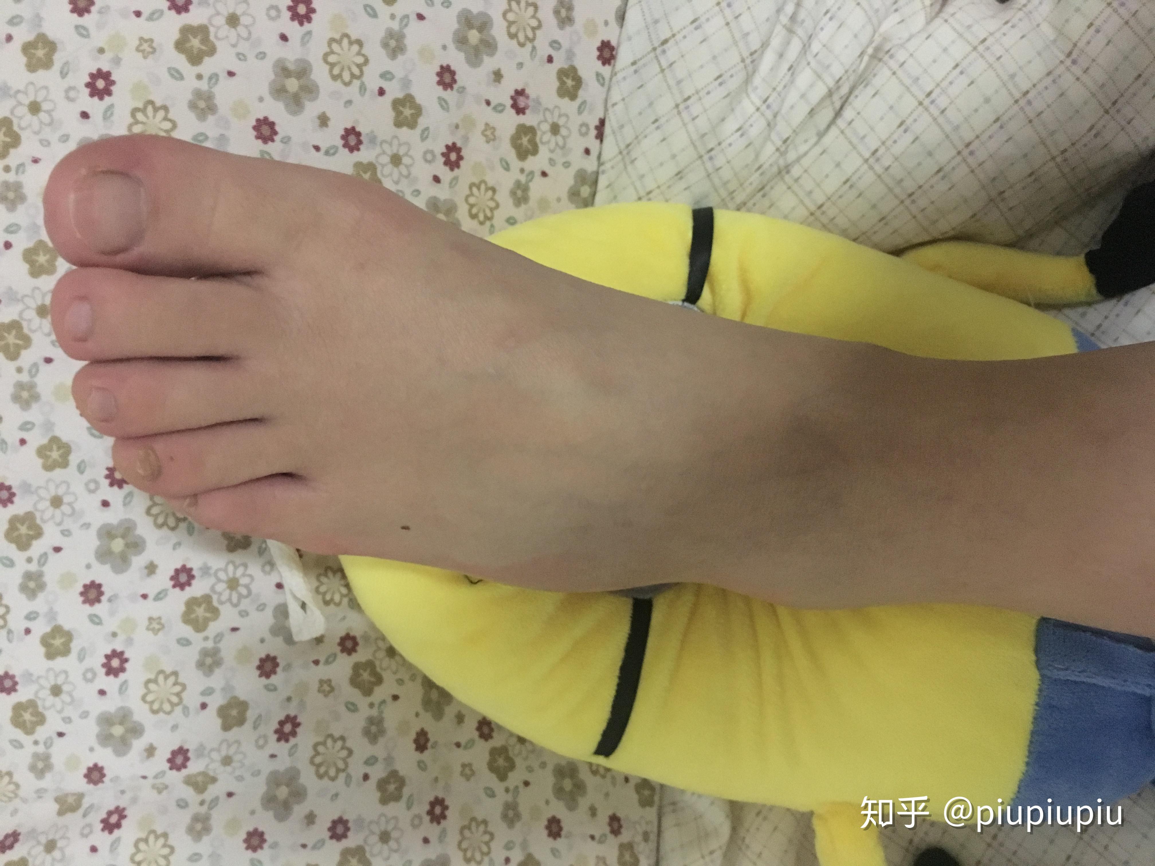 左脚摔骨折,揭秘其背后的奥秘,象征,风水布局,风水,第1张 左脚摔骨折,揭秘其背后的奥秘,象征,风水布局,风水,第1张